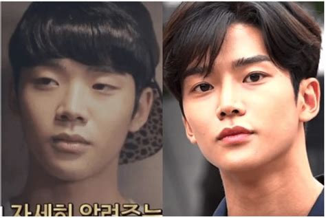 did rowoon have plastic surgery
